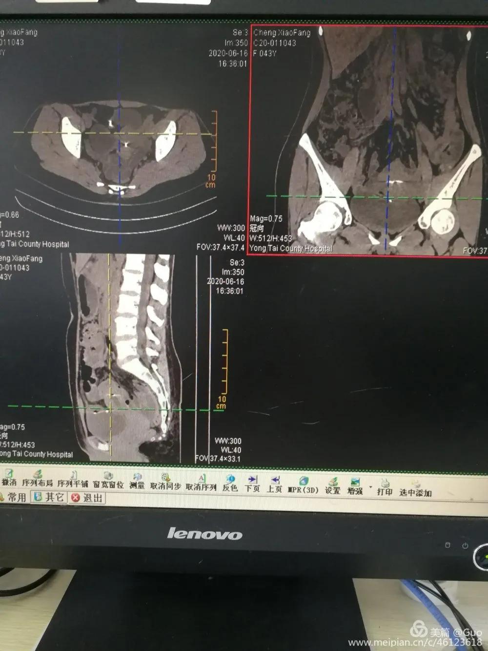 摘除节育环手术,节育环的摘除手术
