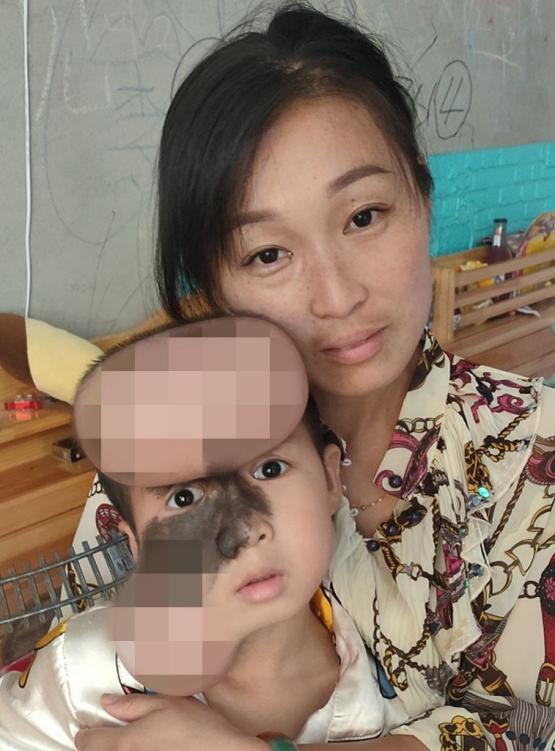 5岁男孩头上长500克重“气球”，历尽5年艰辛只为早日换脸