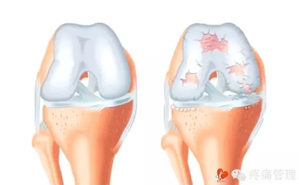 膝盖卡卡的怎么办,膝盖咔咔响疼痛怎么办