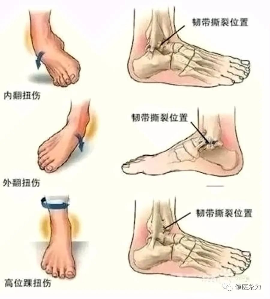国家队康复师崴脚康复动作,国家队队医治疗崴脚