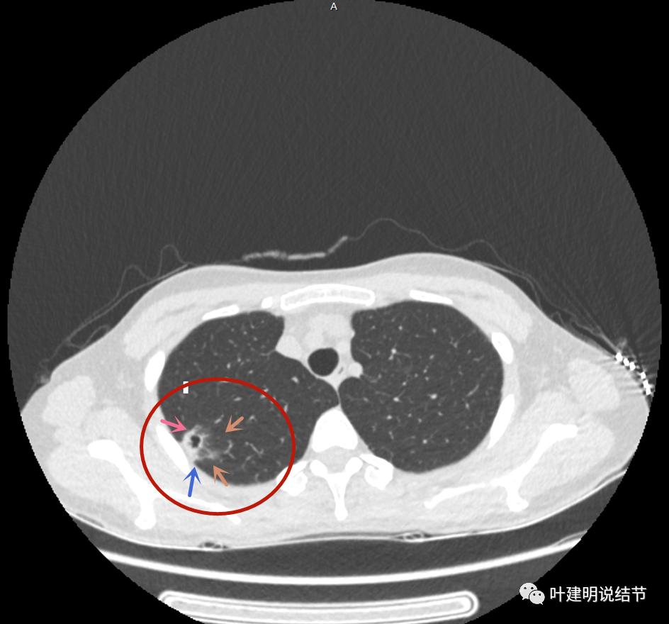 临床诊断孤立性肺结节,空洞型结节一般是什么性质
