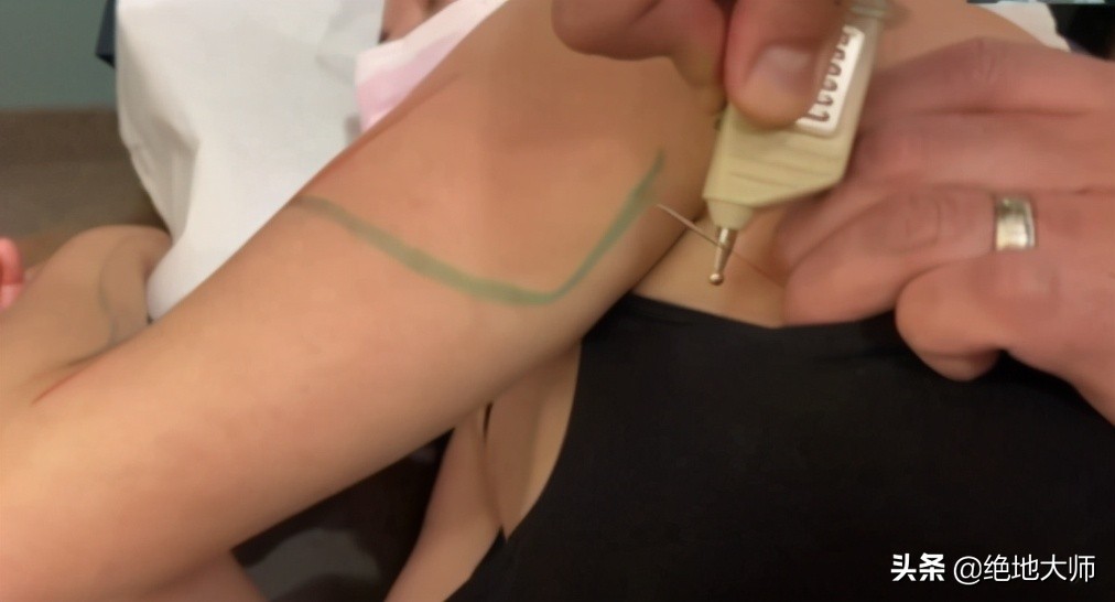 手神经外伤康复视频,治疗手神经损伤的药