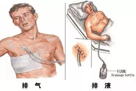 护士观察瞳孔注意事项,胸腔闭式引流的护理及注意事项