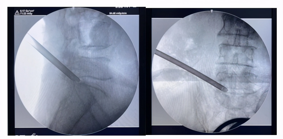赶走疼痛，一身轻松！腰背痛，太原市中心医院疼痛科有妙招
