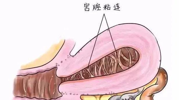 关爱女性｜呵护子宫，不可忽视“宫腔粘连”