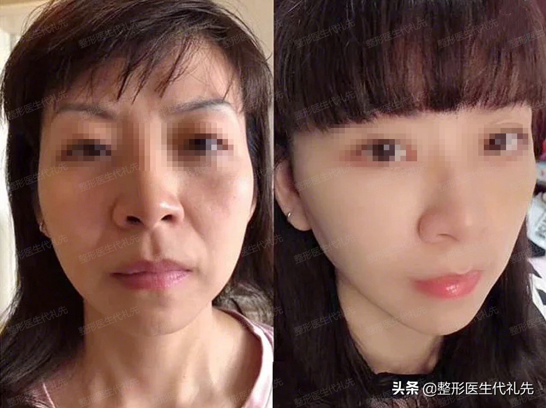 做线雕和不做线雕的好处,面部线雕能改善下颌线吗