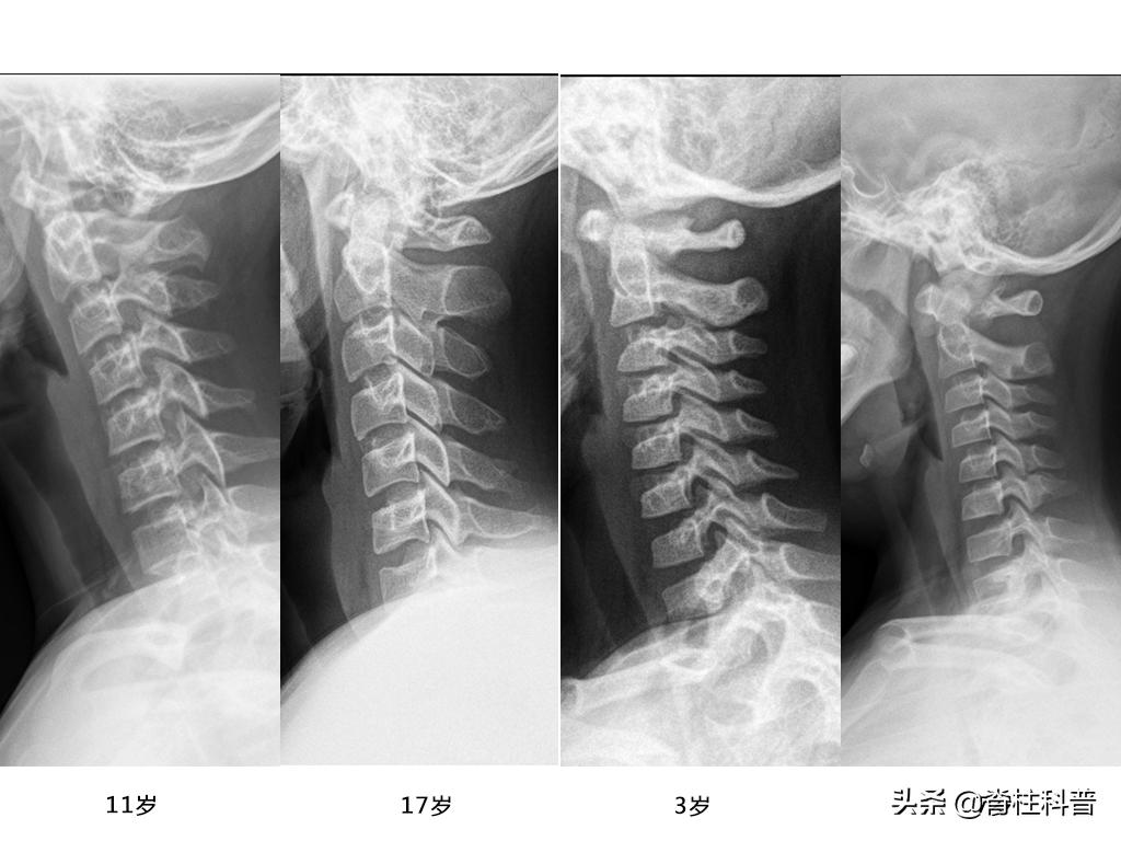 儿童颈椎生理曲度变直头晕头疼,头晕不知道是高血脂还是颈椎病