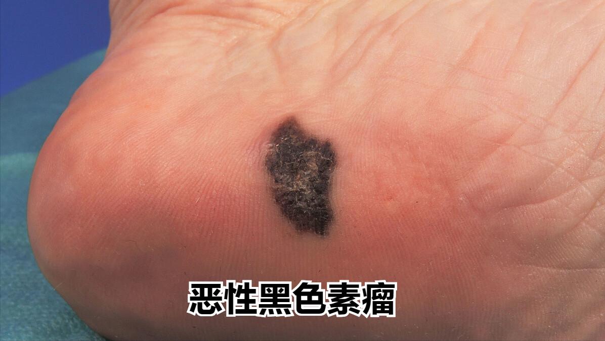 远离皮肤癌，只需要做到这三点，皮肤就会越来越健康