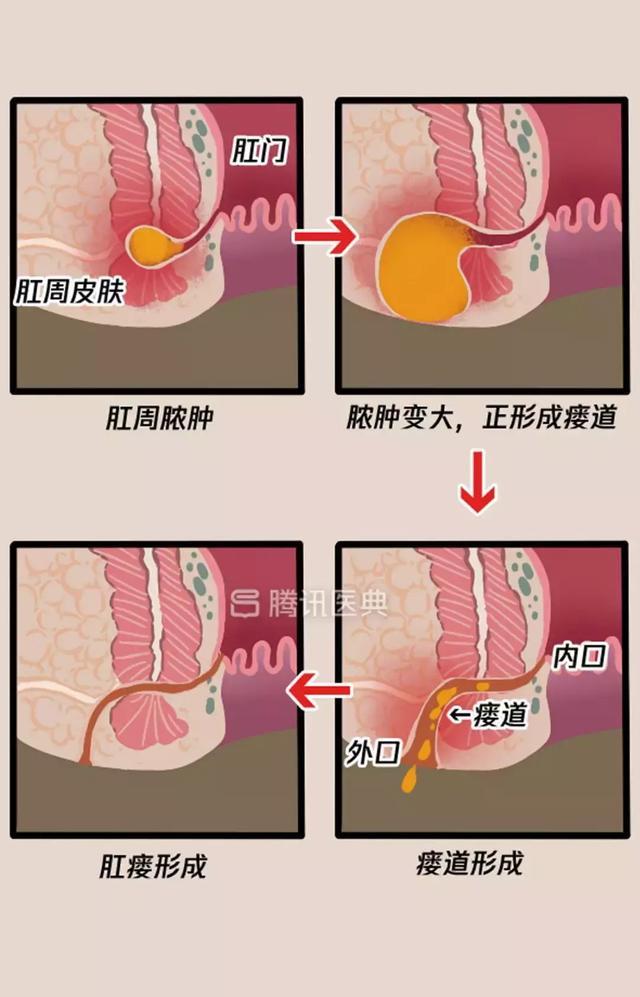 “*菊爆**后”痛到喊妈！真实看病经历泣血奉上，必须保护好菊花