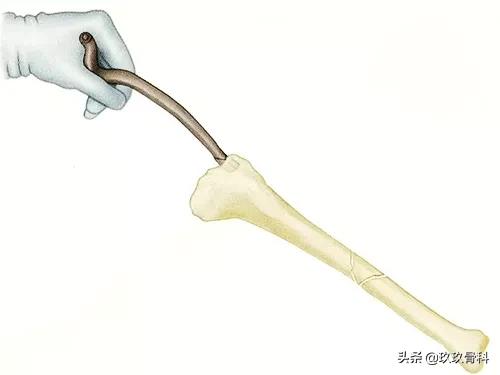 胫腓骨骨折髓内钉手术方式,髓内钉骨折最佳治疗方案