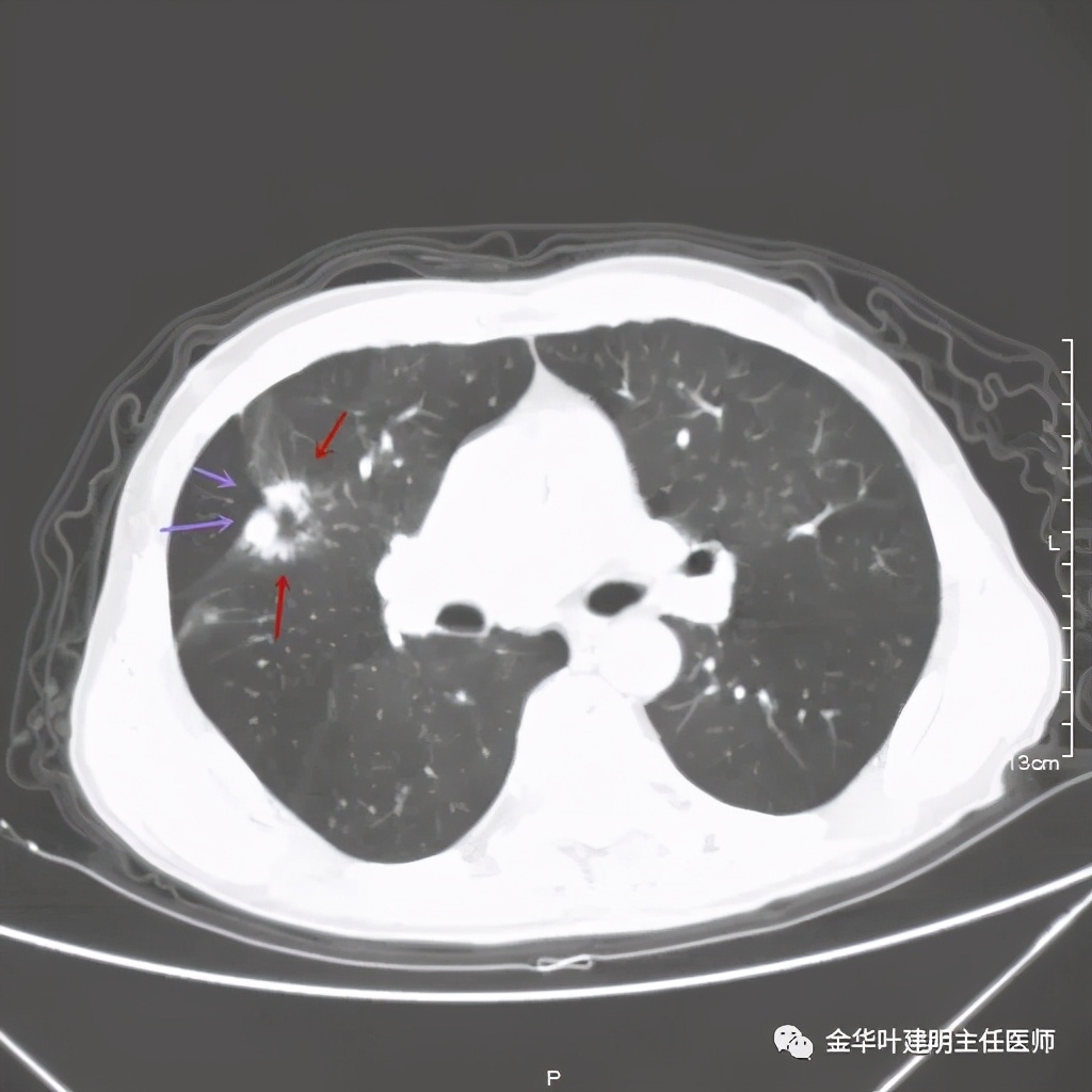 左肺占位被安排穿刺活检是肺癌吗,肺癌肺部穿刺有什么危险