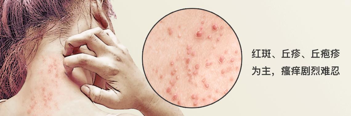 治疗皮炎湿疹的口服药物,口服治湿疹的药物有哪些