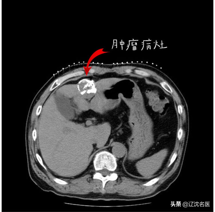 肝癌做放射性粒子治疗有什么影响,乏力查出来癌症