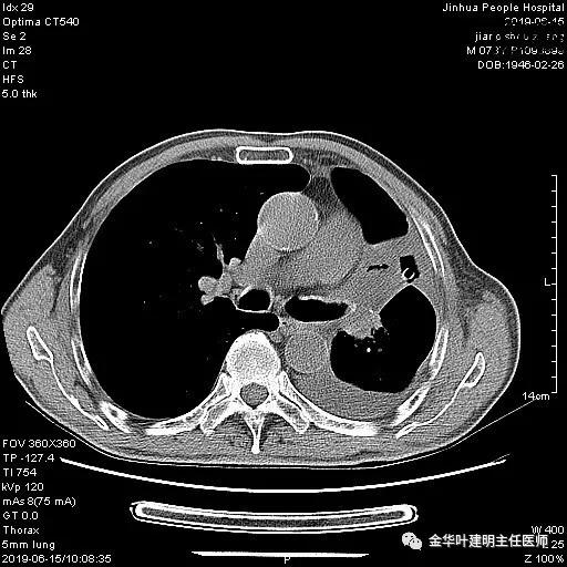 手术引起乳糜胸,有没有做了肺结节手术后是误诊的