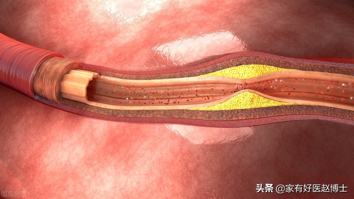 血压高低密度胆固醇3.3要吃他汀吗,血压高胆固醇高怎么降