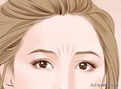 川字纹抬头纹鱼尾纹全脸年轻化,川字纹抬头纹鱼尾纹法令纹去除