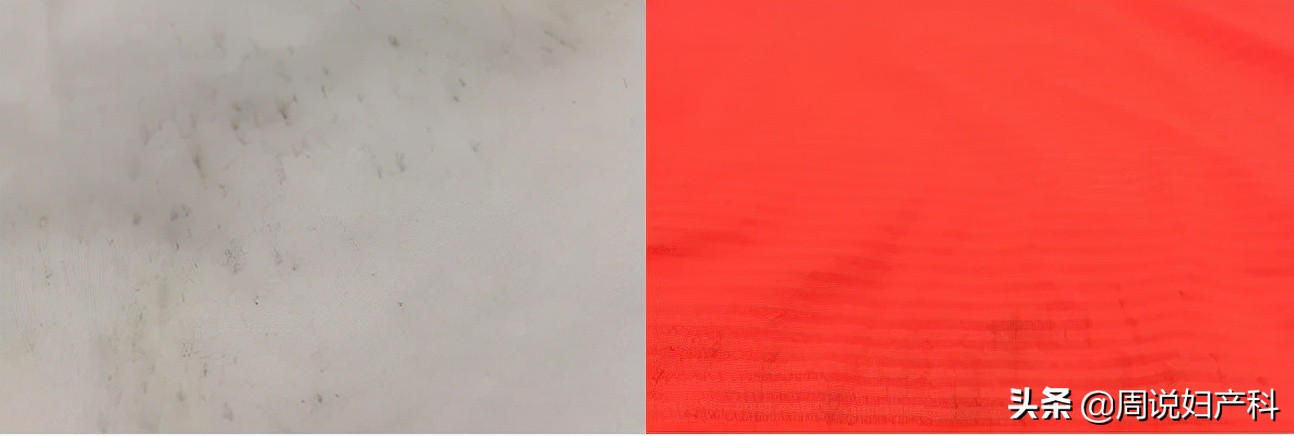 *裤内**长霉点还能穿吗？女性更要注意