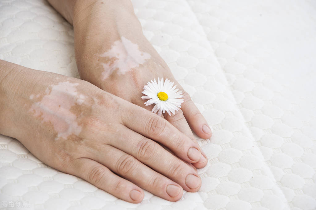 被误解的白化病:会传染?和白癜风一样?不能结婚生小孩?