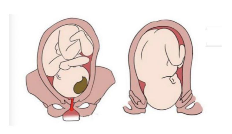 女人生产后的崩溃,女人分娩三大尴尬事情