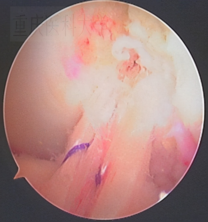 前交叉韧带损伤核磁共振,前后交叉韧带损伤的治疗