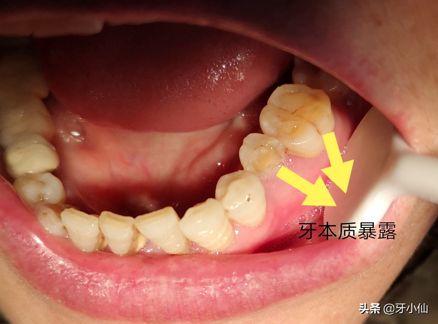 牙太痛,吃不了热辣火锅、冰爽雪糕、酸甜水果,怎么能当吃货?