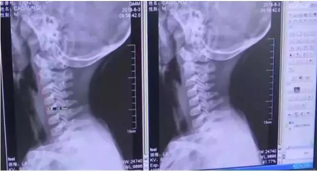 5岁孩子眼睛近视200度还伴有轻微散光？别再让手机代替你去陪孩子