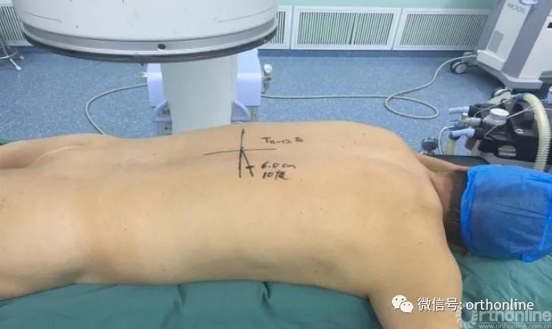 胸椎怎么做微创,脊柱内镜微创操作流程