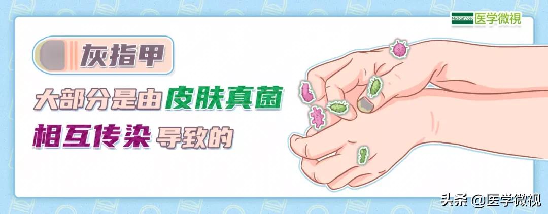 灰指甲三年没治好怎么办,大脚趾灰指甲口服了半年药不见好