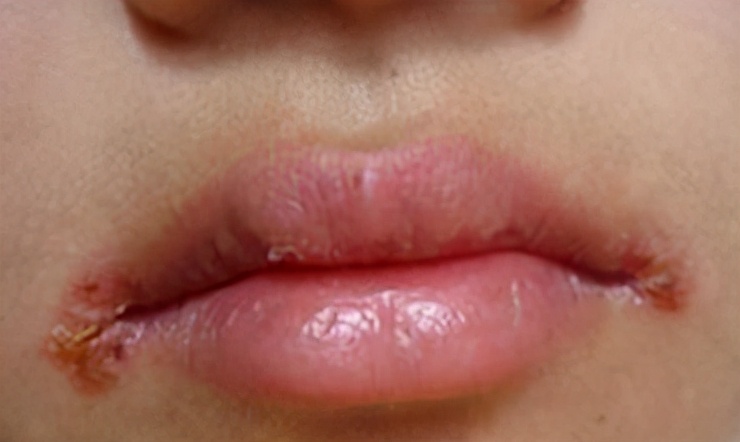 烂嘴角最快的解决办法,吃腊肉上火烂嘴角是什么原理
