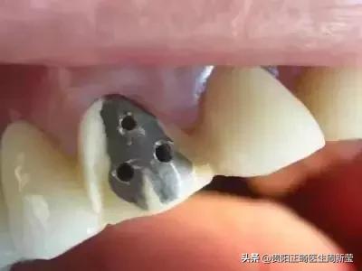 烤瓷牙做过后最好的修复方法,烤瓷牙里面的真牙烂了怎么办