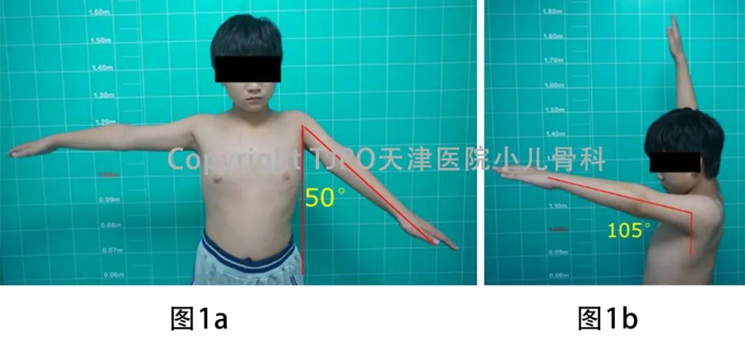 小儿骨科矫正足内翻,宝宝足内翻矫形支具