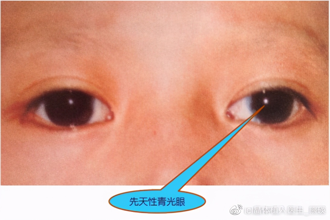 小孩6岁有远视需要治疗吗,儿童眼病的种类和表现症状