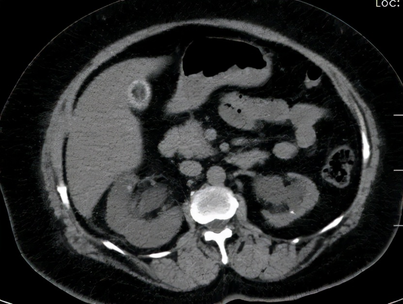 有没有一个肾大一个肾小的情况,肾少了一个行吗