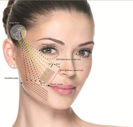 埋线提升,埋线提升需要几根线