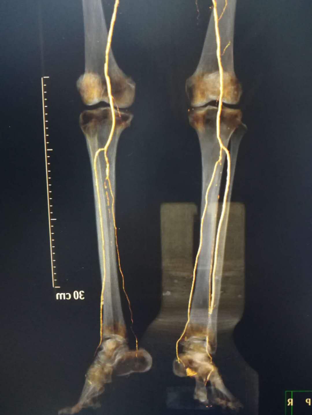 负压封闭引流治疗糖尿病足的原理,糖尿病足血管闭塞怎样治疗好