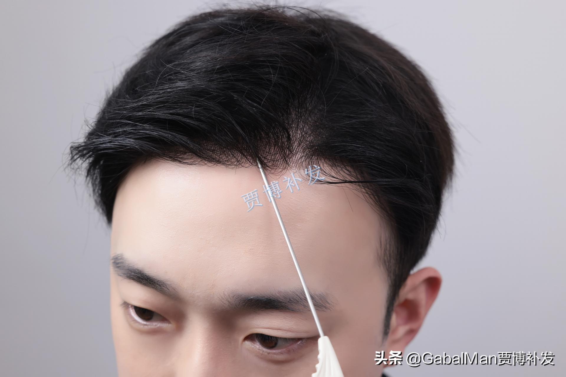 60分钟拯救你的秃头形象,发际线高拯救视频