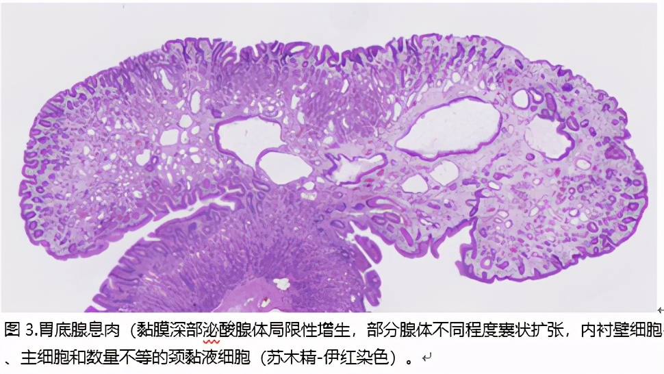 胃息肉可怕不,做胃镜查出胃里有息肉怎么办