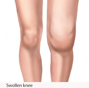 膝盖滑膜炎怎么回事,滑膜炎三大症状