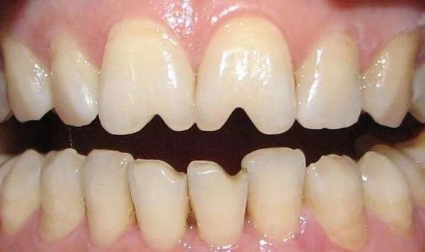 吃出“瓜子牙”,怎样才能恢复如初?