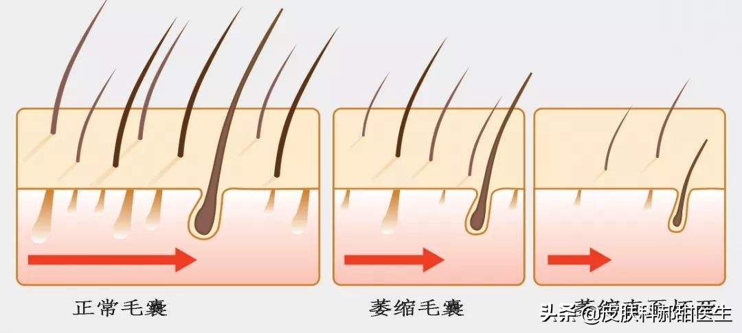 治疗脱发目前有什么好的办法吗,治疗脱发怎么治