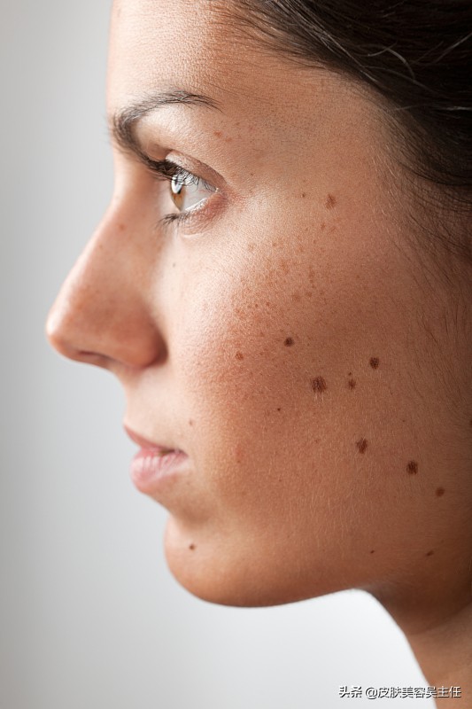 激光祛斑出血和水泡多久可以结痂,激光祛斑结痂不小心擦掉了怎么办