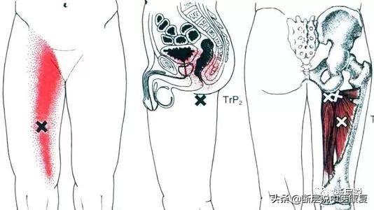 女性盆底健康问题，针刺要扎三阴交，手法要选内收肌