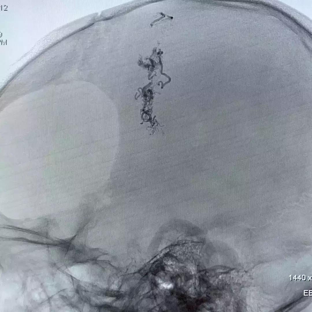 北京三博脑科医院康复治疗,北京三博脑科医院治脑血管瘤怎样