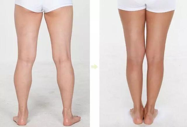 小腿粗怎么办快速瘦十斤,小腿粗如何变细腿简单的方法