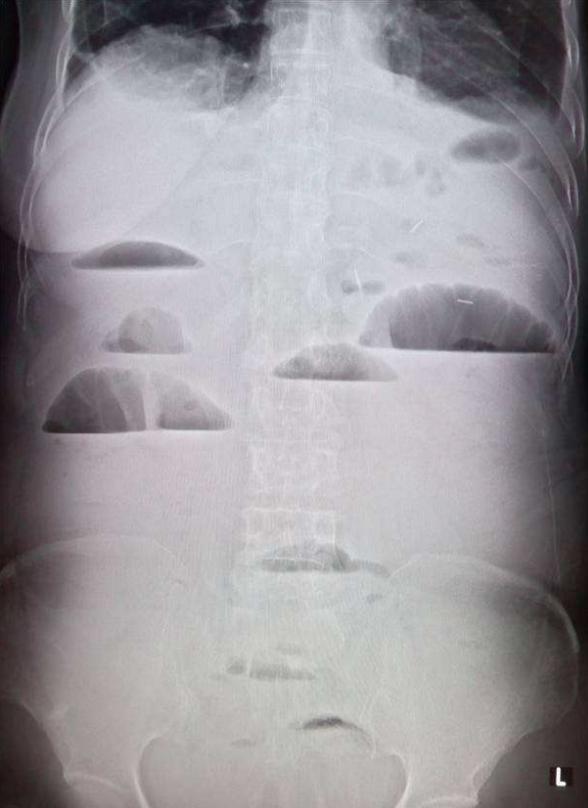 腹腔积液严重吗怎么治疗,癌症引起恶性胸腹腔积液