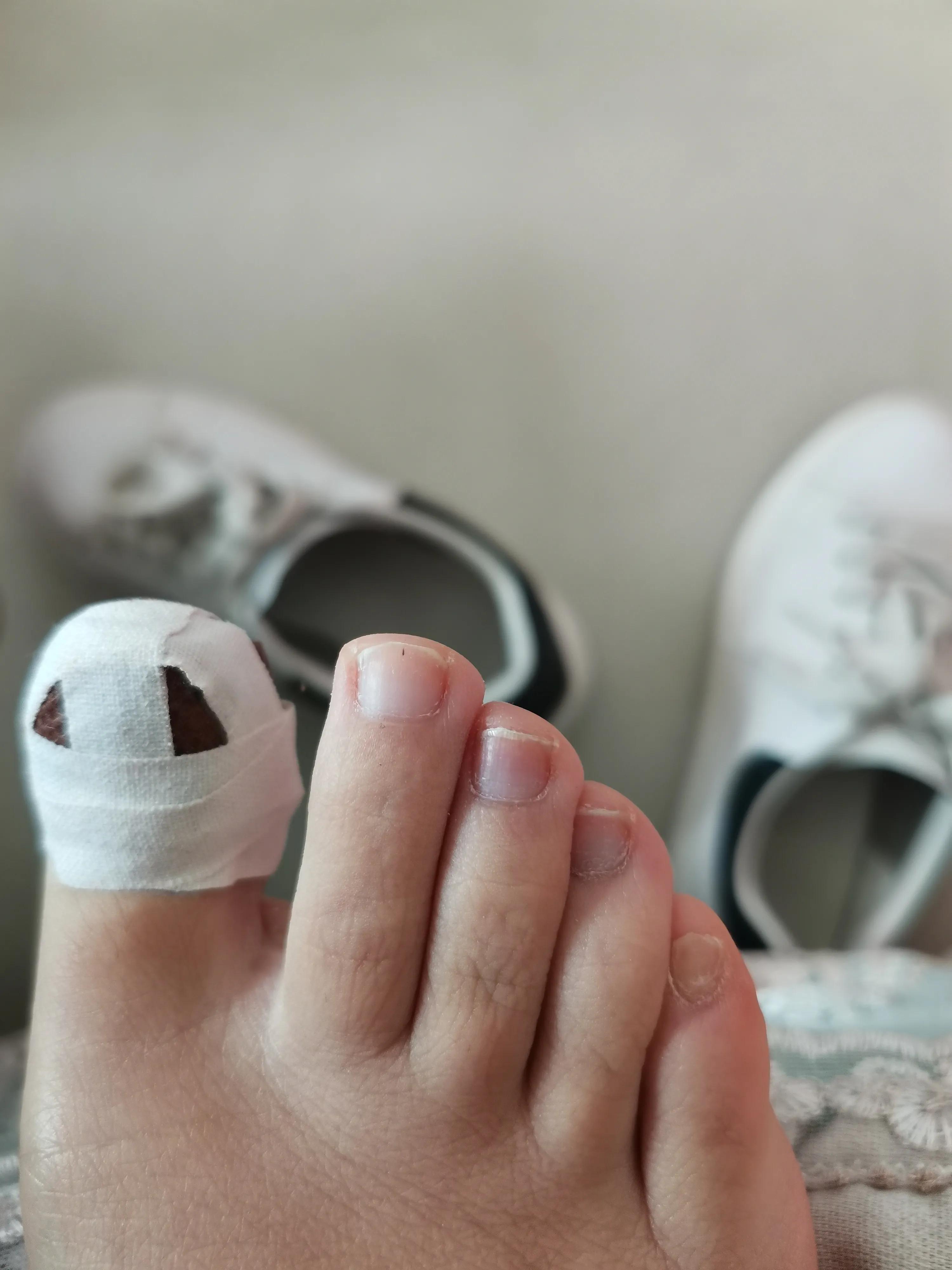 灰指甲加嵌甲治疗大概需要多少钱,灰指甲嵌甲怎么根治