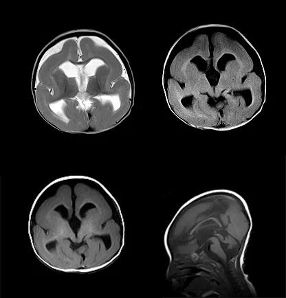 先天性颅脑发育不全,先天颅脑发育不良能治吗