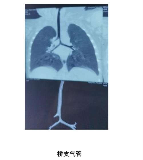 宝鸡市妇幼保健院：呼吸内镜中心发现一例罕见气道发育异常——桥支气管