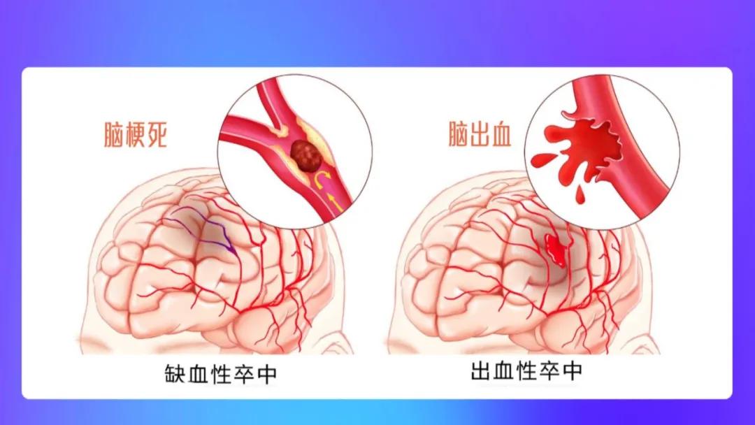 脑中风的急救口诀大全,脑中风前兆及应急措施动画