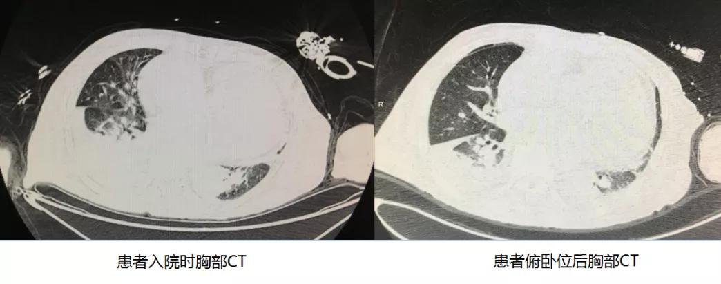 抢救心脏骤停死亡,抢救心脏骤停无效死亡